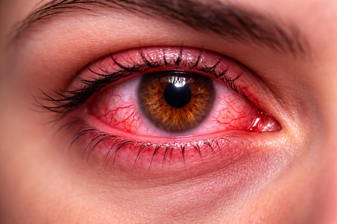 The Hidden Danger Behind Red Eyes: Eyelash Mite