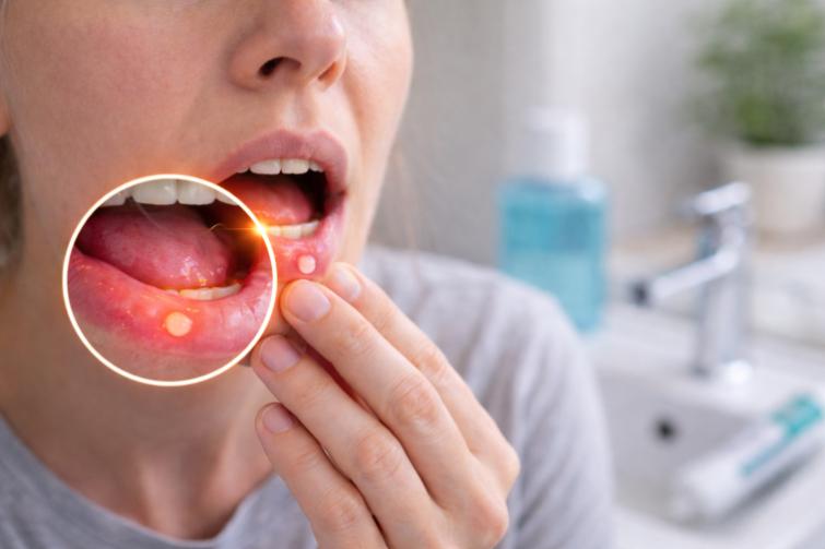 What Is a Mouth Ulcer (Canker Sore)? When Should It Be Taken Seriously?