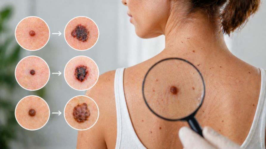 Do Not Underestimate Changes in Moles: An Early Warning Guide for Your Skin Health