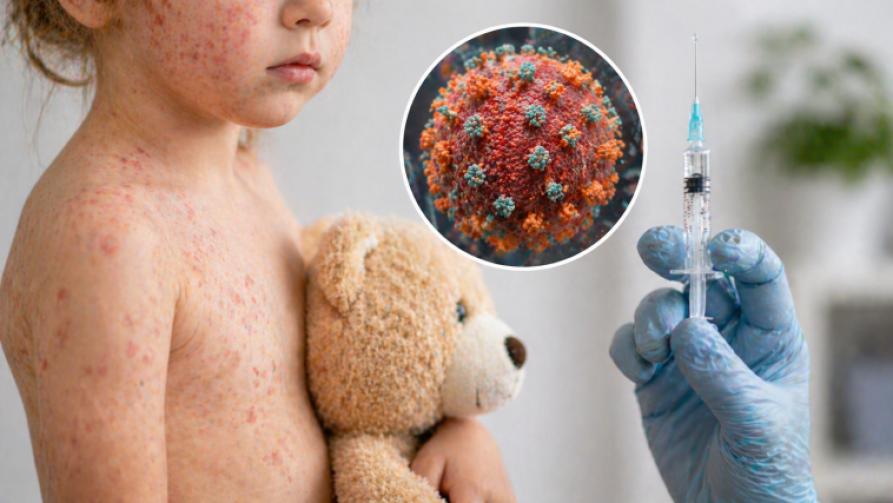 What Is Measles? Why Is Vaccination Important?